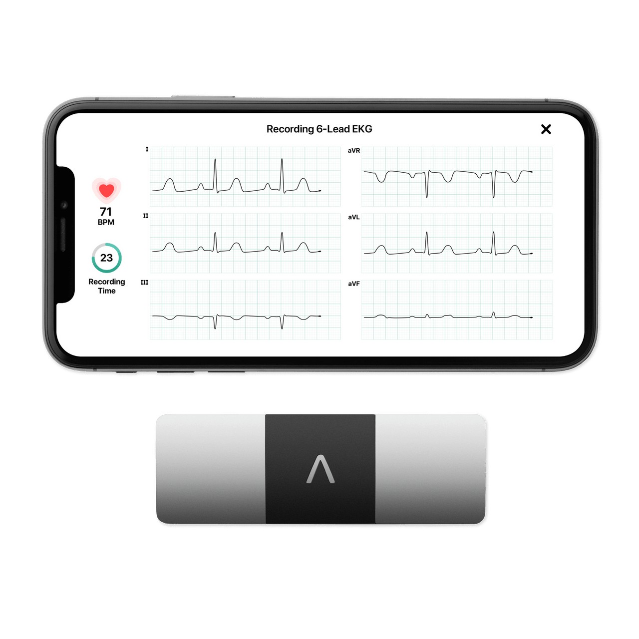 Appareil ECG AliveCor KardiaMobile 6L et son tracé à six dérivations affiché sur un smartphone